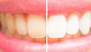 Teeth Whitening Program