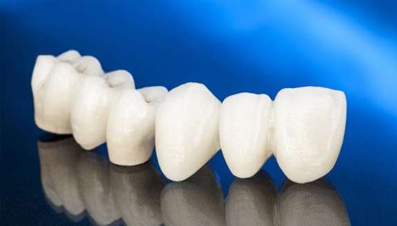 Benefits of CEREC Dental Crowns