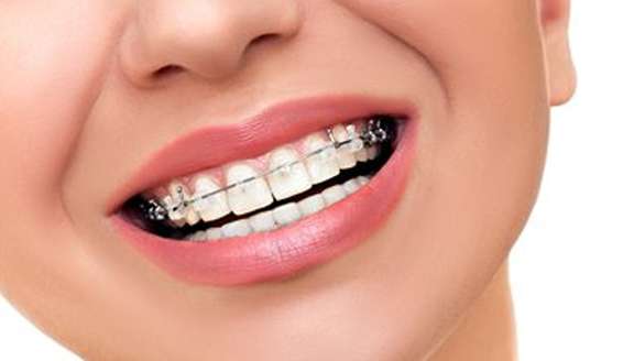 Early Orthodontic Treatment