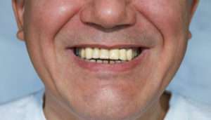 Restore your smile