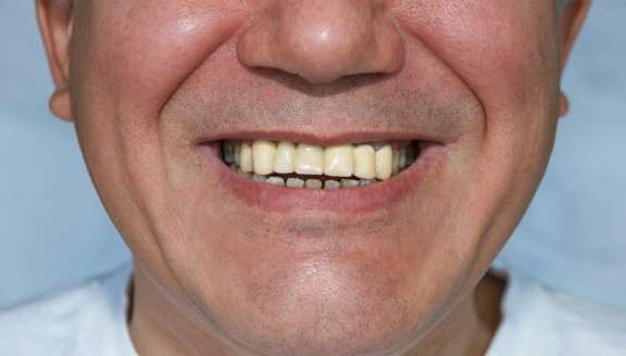 Fight Tooth Discoloration with Teeth Whitening