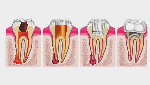 Heroes Dental & The ‘R’ Word: Root Canal