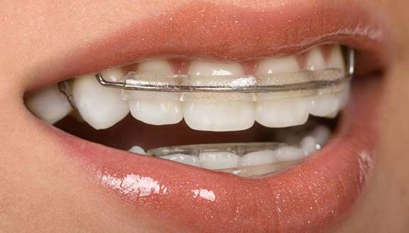 9 Amazing Tips for Protecting Your Retainer
