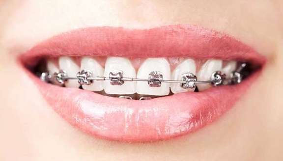 Heroes Dental Orthodontics: The Benefits of Straight Teeth