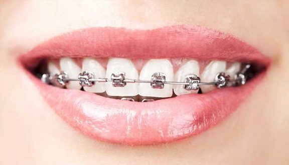 It’s Never Too Late for Adult Braces
