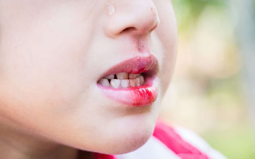 Dealing With Tooth Trauma While Out of Town