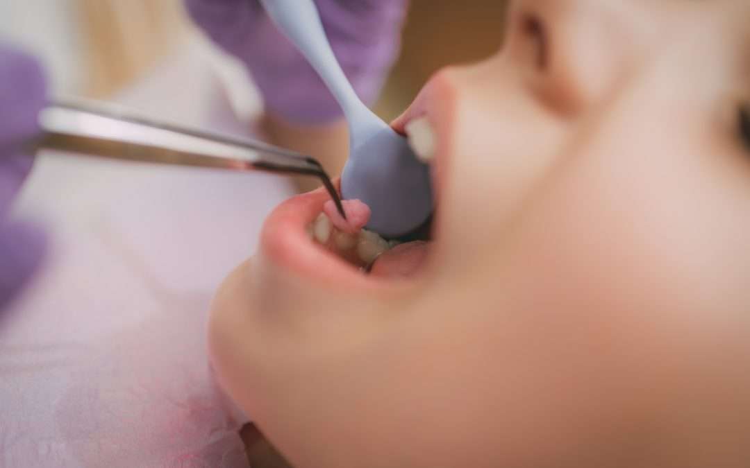How Dental Sealants Can Help Protect Your Child’s Teeth