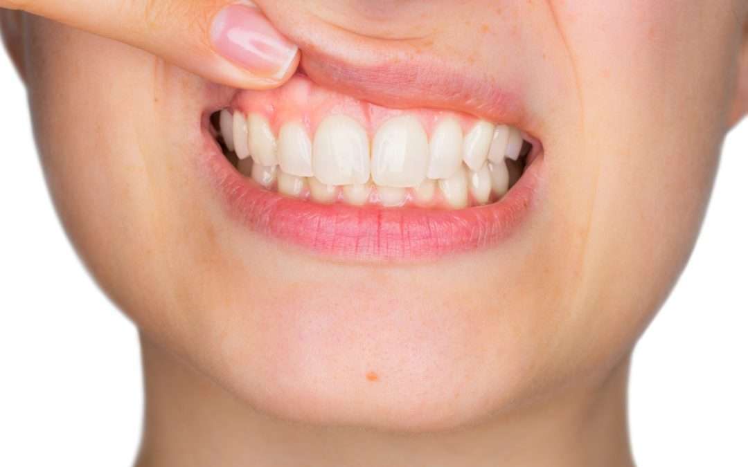 Celebrate National Gum Care Month with Heroes Dental!