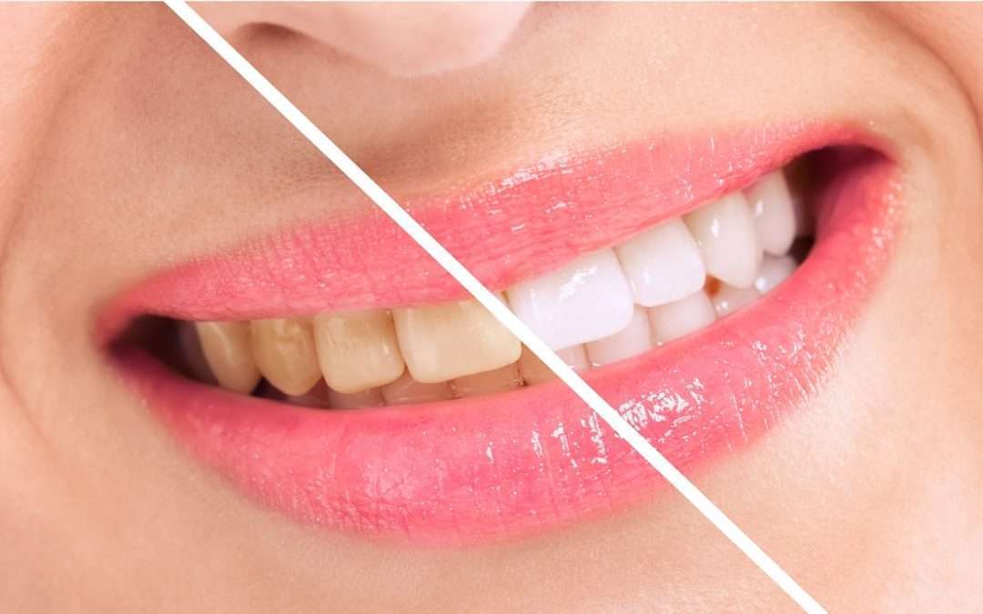 The Importance of Teeth Whitening