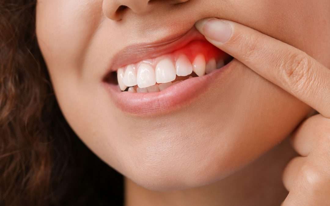 Gingivitis vs. Periodontitis: The Key Differences