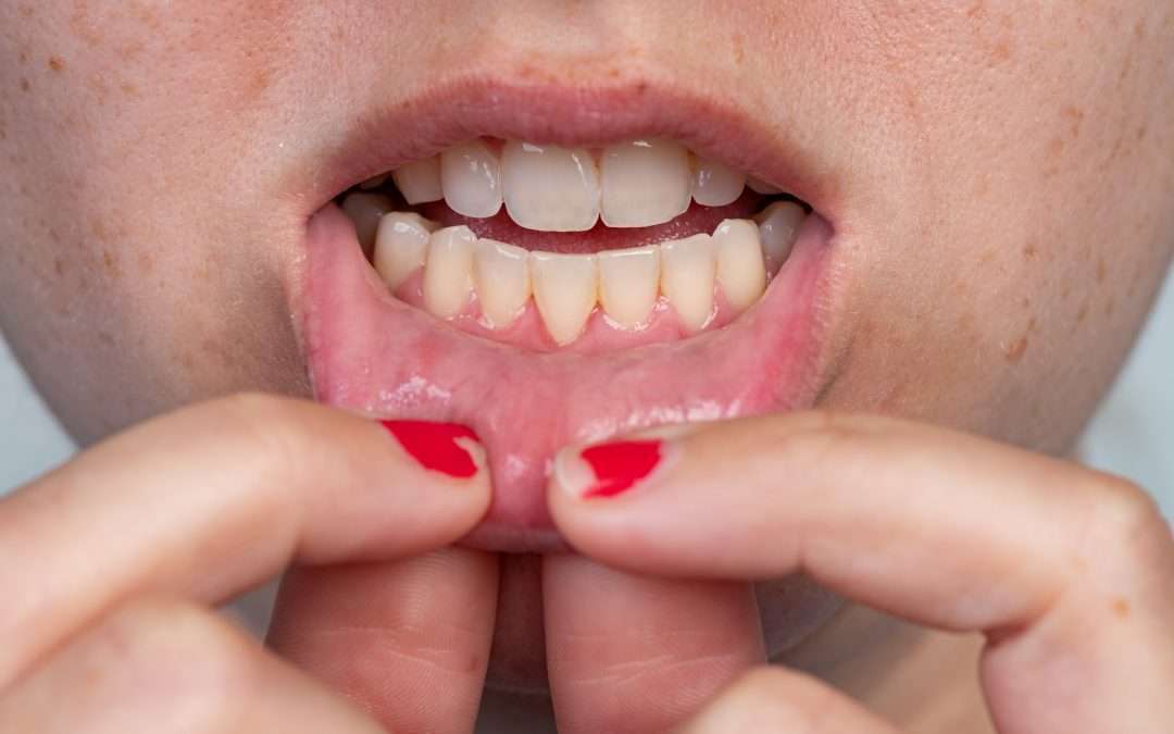 How to Fix Receding Gums: Receding Gums Treatment