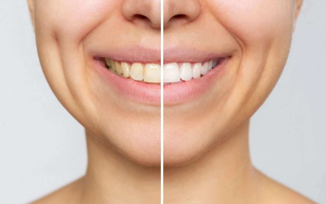 McAllen Pediatric Dentists Share the “Whole Tooth, and Nothing but the Tooth” About Tooth Enamel