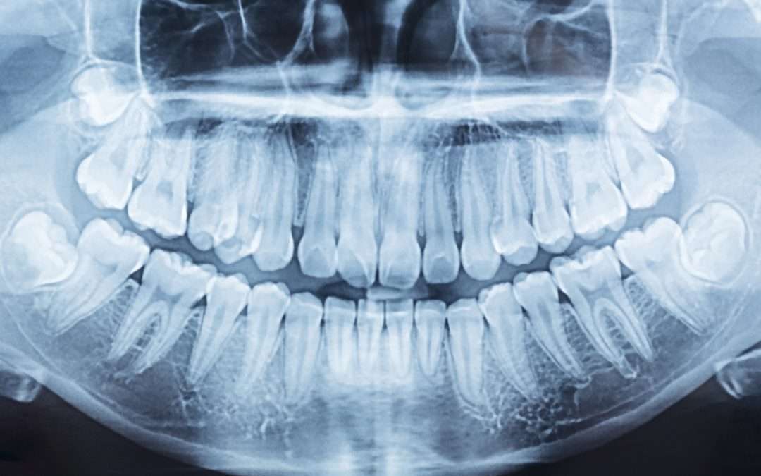 Wisdom Teeth Aren’t Scary: Learn the Facts From a McAllen Dentist