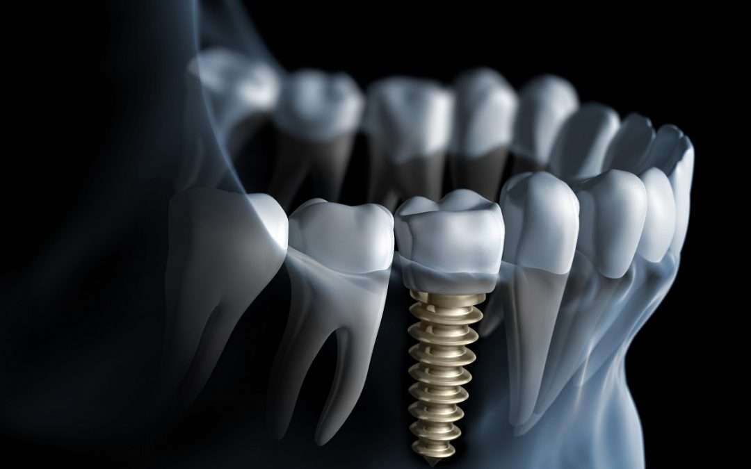 Lost a Tooth? Learn Why You Should Replace a Missing Tooth Immediately