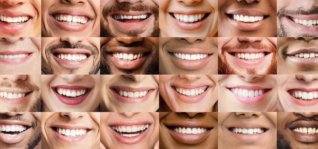 Can Professional Teeth Whitening Make Your Teeth as White as Snow?