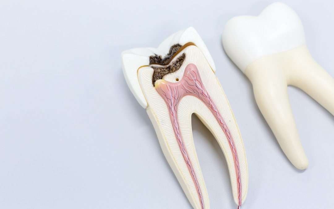 Just How Common Are Root Canals?