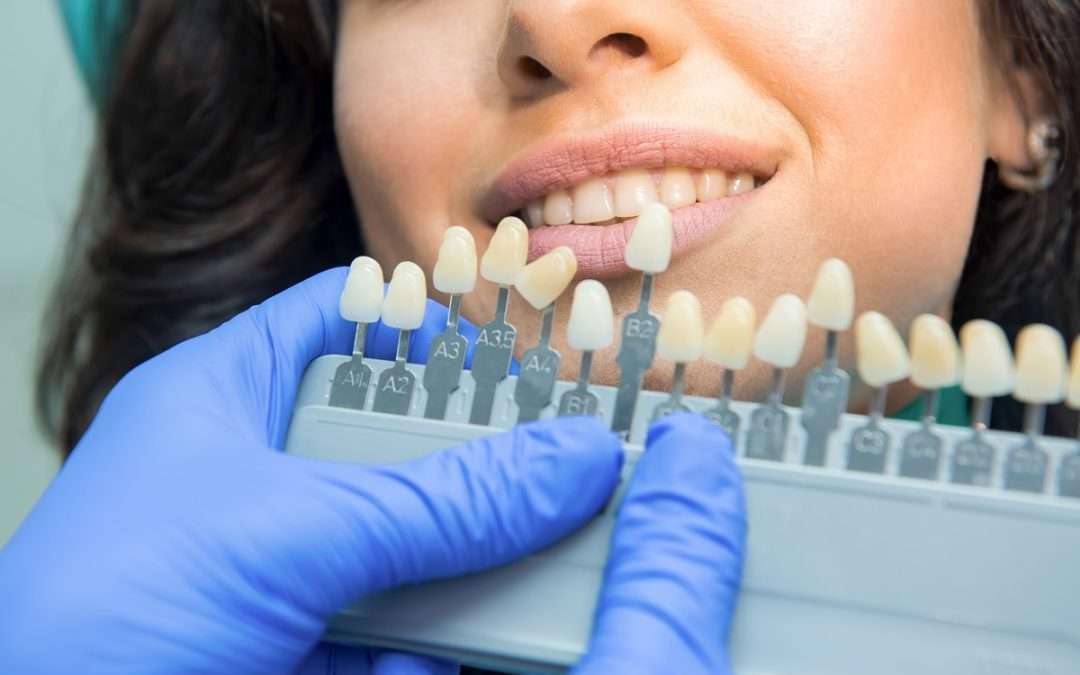 Preparing for a Teeth Whitening Treatment? 5 Things You Should Do To Get Ready!