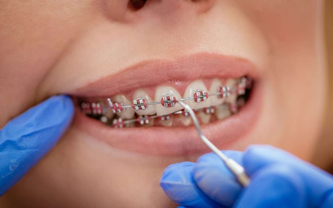 How Long Do Braces Take To Work?