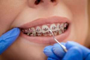 A hand wearing a blue medical glove uses a tool on the wire of braces.