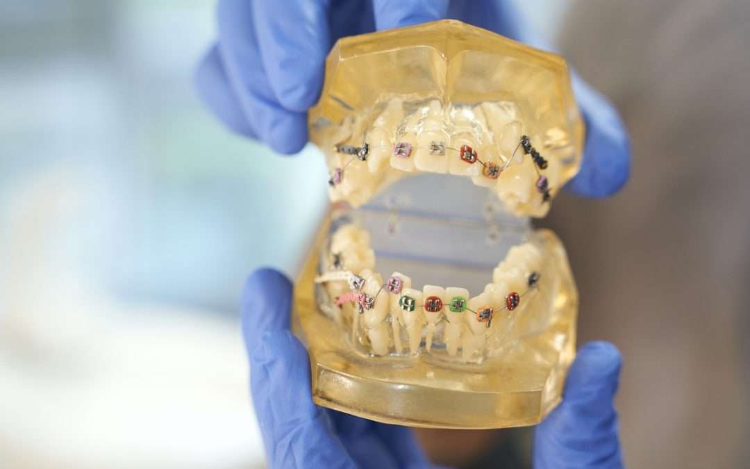 Your Braces FAQs, Answered! Get the Information You Need to Protect Your Teeth!