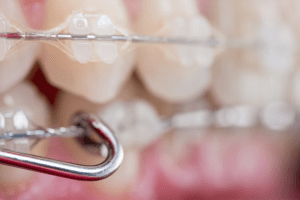 An extreme close-up of teeth with clear braces and a dental implement