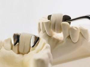 A Maryland dental bridge