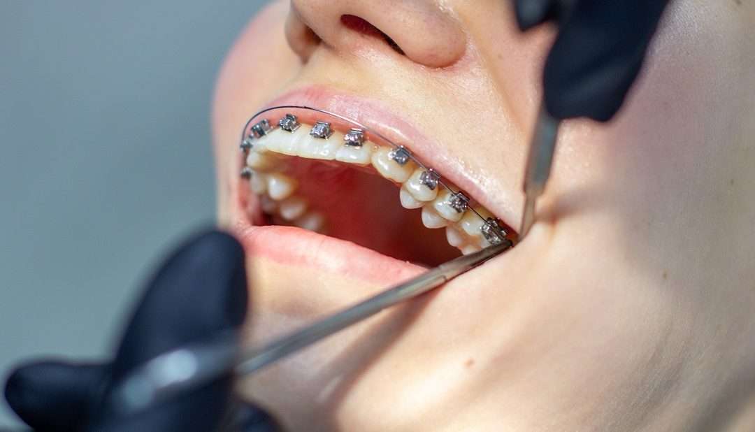 McAllen Braces Quick Facts: What You Need To Know Before Getting Braces in McAllen
