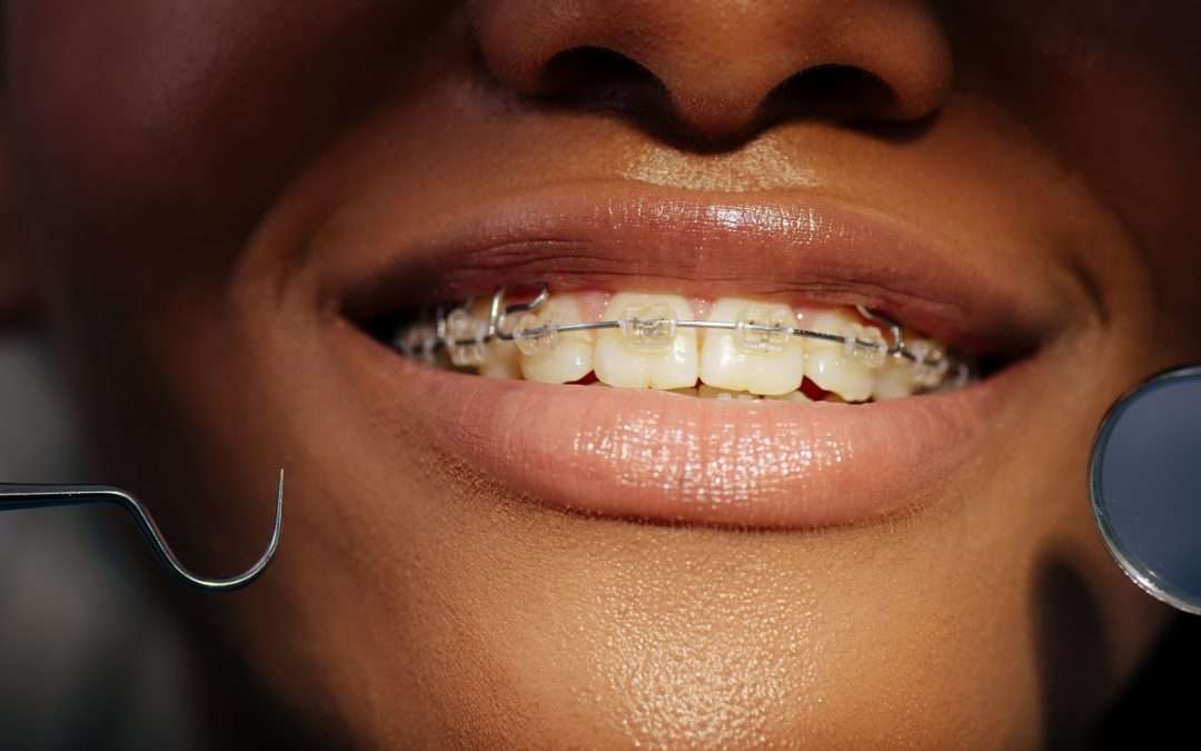 The 3 Types of Braces: Which McAllen Braces Are Right for You?